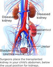 Kidney bigger