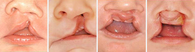 Cleft lip quadriptych