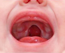 Cleft Palate