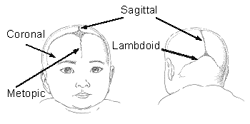 Craniosynostosis