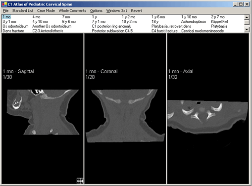 Cervical Spine Atlas Screen Shot 2