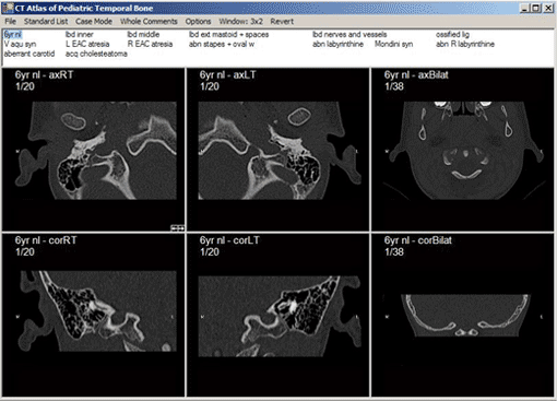 Temporal Bone Atlas Screen Shot 2